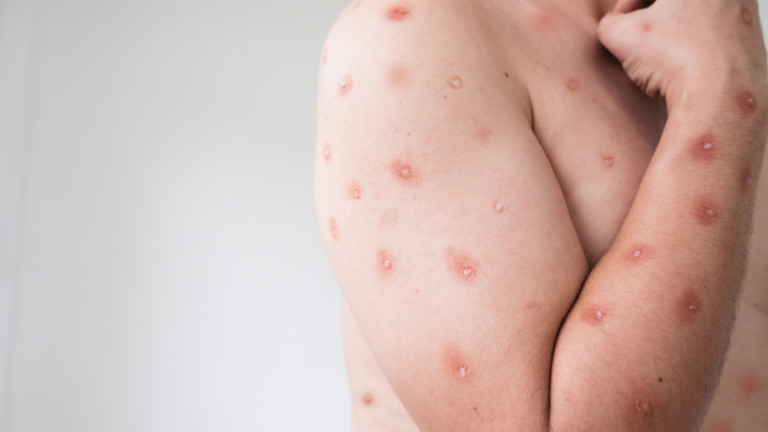 Mpox Retorna ao Radar da Saúde Pública: O Brasil em Alerta Máximo