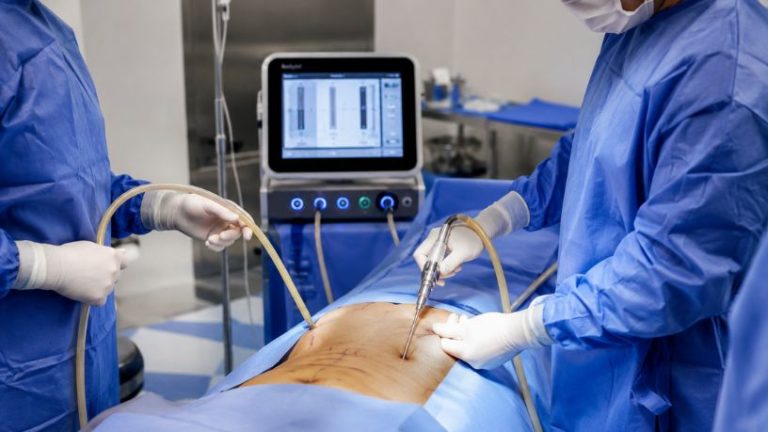 Lipoaspiração com tecnologia redefine contornos atléticos e impulsiona busca por resultados naturais